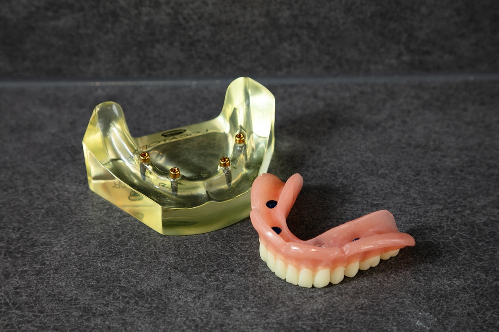 失った歯を取り戻し、もう一度、自分らしく噛める毎日へ