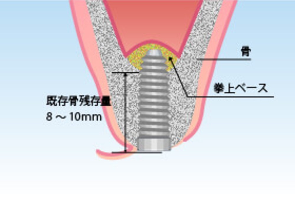 ソケットリフト